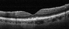 tomografia optica coherente oct drusas